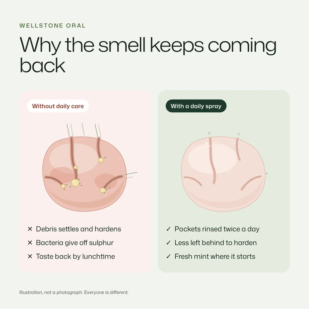 Why the smell keeps coming back: tonsil pockets without daily care versus with a daily spray