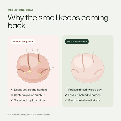 Why the smell keeps coming back: tonsil pockets without daily care versus with a daily spray