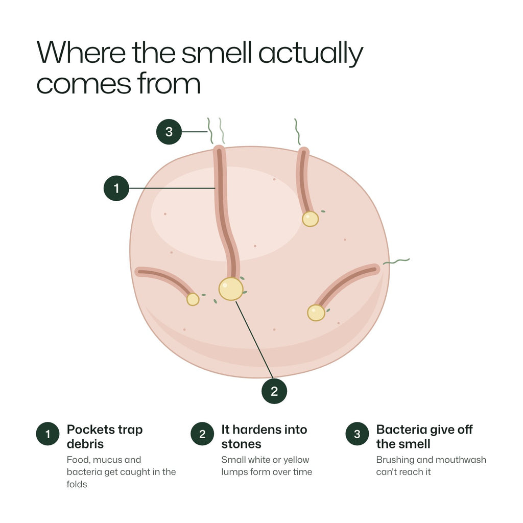 Diagram of a tonsil showing where tonsil stones and the smell come from