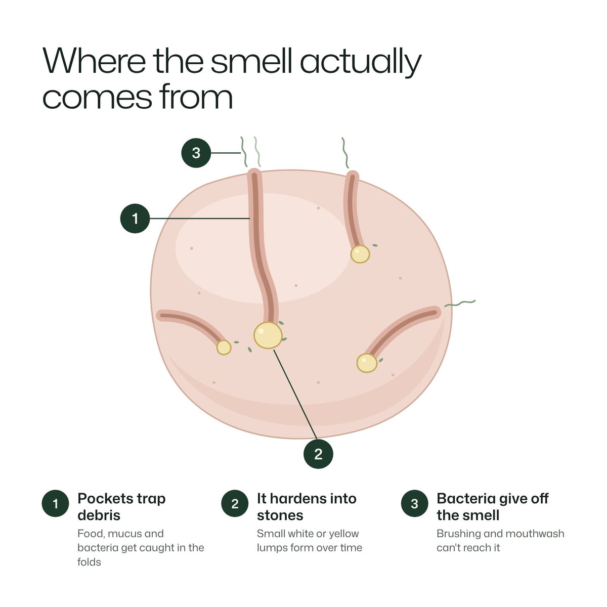 Diagram of a tonsil showing where tonsil stones and the smell come from